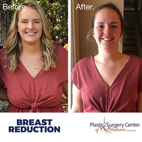 Breast Reduction Before and After Photos Melbourne, FL.